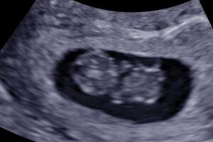 9 Weeks Pregnant: Baby Growth & What to Expect