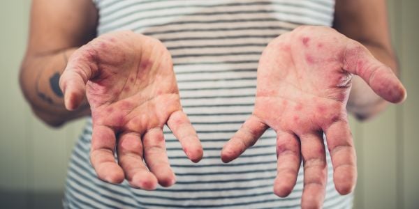 Hand, Foot, and Mouth Disease (HFMD): Symptoms, Causes, and Treatments (Essential Guide + 10 Facts)