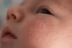 How to treat baby acne