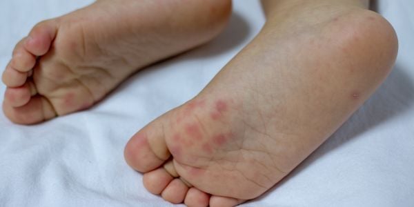 Hand, Foot, and Mouth Disease (HFMD): Symptoms, Causes, and Treatments (Essential Guide + 10 Facts)