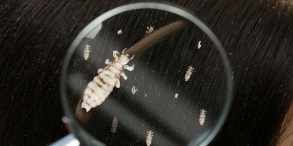 Head lice exposure can be frustrating, but with early detection, proper treatment, and prevention, you can keep your home lice-fre
